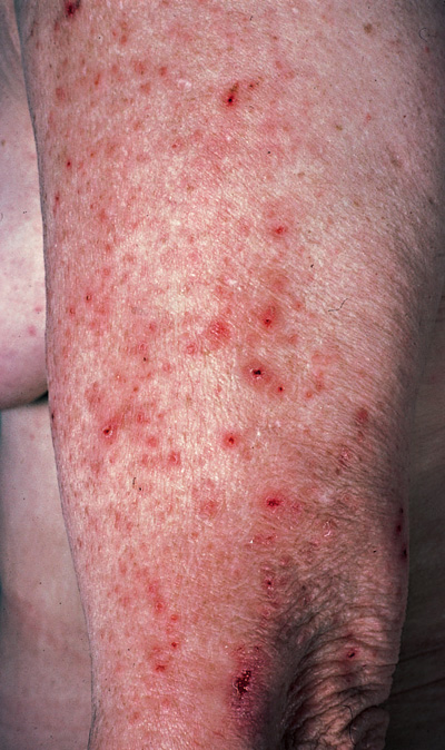 Contact Dermatitis and Related Conditions