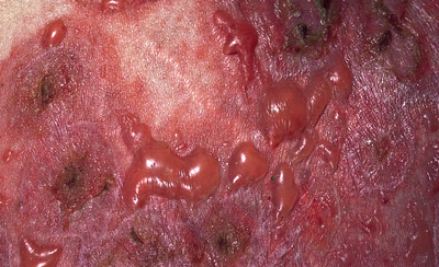 Dermatitis herpetiformis