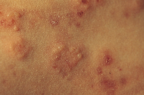 Dermatitis herpetiformis (ziekte van Duhring) - Huidziekten.nl